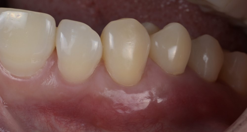 治療後